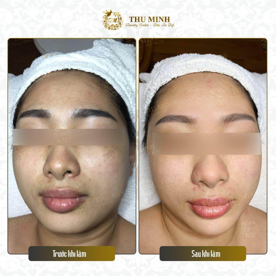 Điều trị nám da mặt tại Thu Minh Beauty - hiệu quả 99%